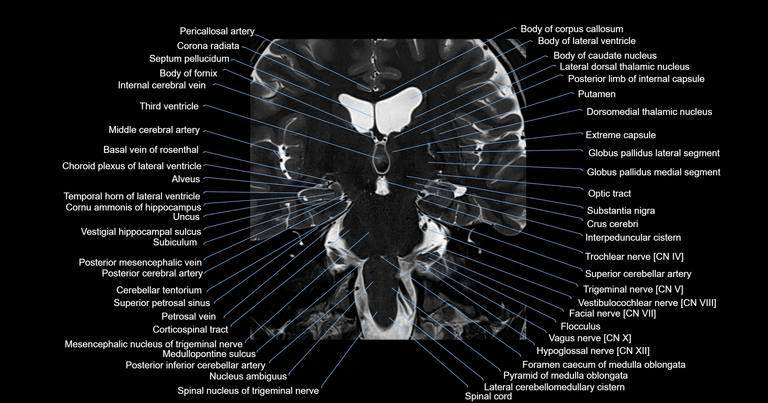 MRI brainstem & basal ganglia anatomy labelled 3T MRI images -img-00001-00021.webp